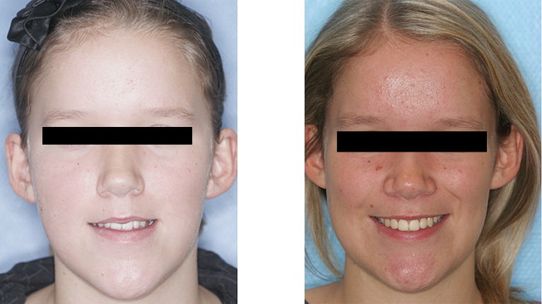 Billede af pige forfra før og efter operation