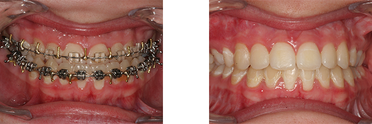 Før og efter billede af mund med skævbid
