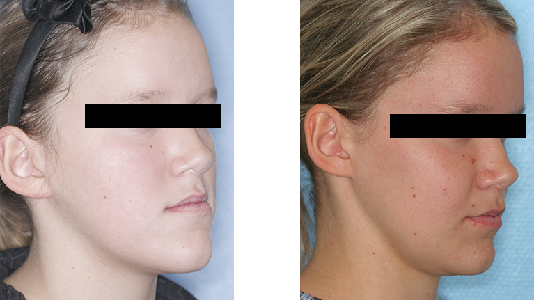 Billede af pige skråt forfra før og efter operation