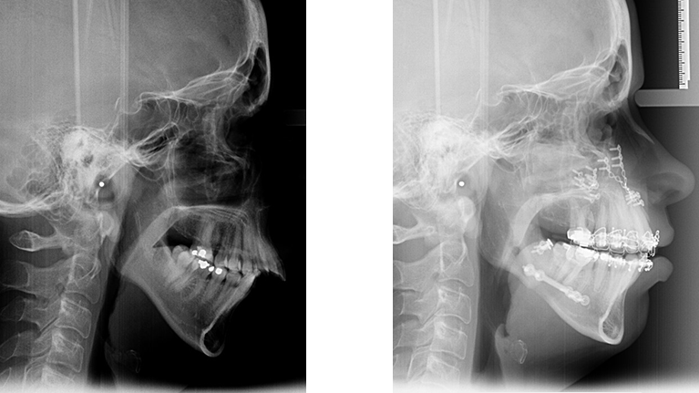 Røntgenbillede af pige fra siden før og efter operation
