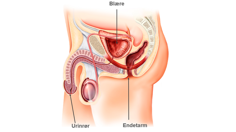 Mandens underliv efter fjernelse af prostata