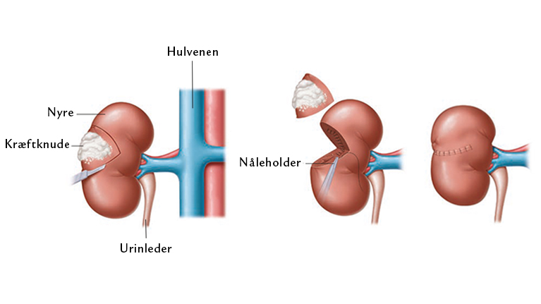 På billedet vises, hvordan man kun fjerner knuden og det omkringliggende væv i nyren og efterfølgende syr nyren sammen igen