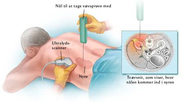Illustration af vævsprøvetagning