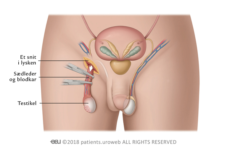 Illustration af operation med fjernelse af testikel
