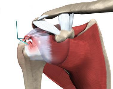 rotator cuff tear 2.jpg
