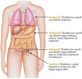 Kroppen med pile og linjer, der angiver, hvor meget kræften har spredt sig. Billedet har følgende tekst: "Stadium IV: Kræften har spredt sig udenfor bughulen. Stadium IIII: Kræften har spredt sig udenfor æggestokkene, men er stadig begrænset til bughulen. Stadium II: Kræften har spredt sig udenfor æggestokkene, men er stadig kun begrænset til bækkenet. Stadium I: Kræften er stadig begrænset til den ene eller begge æggestokke."
