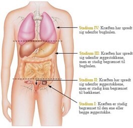 Kroppen med pile og linjer, der angiver, hvor meget kr&aelig;ften har spredt sig. Billedet har f&oslash;lgende tekst: "Stadium IV: Kr&aelig;ften har spredt sig udenfor bughulen. Stadium IIII: Kr&aelig;ften har spredt sig udenfor &aelig;ggestokkene, men er stadig begr&aelig;nset til bughulen. Stadium II: Kr&aelig;ften har spredt sig udenfor &aelig;ggestokkene, men er stadig kun begr&aelig;nset til b&aelig;kkenet. Stadium I: Kr&aelig;ften er stadig begr&aelig;nset til den ene eller begge &aelig;ggestokke."