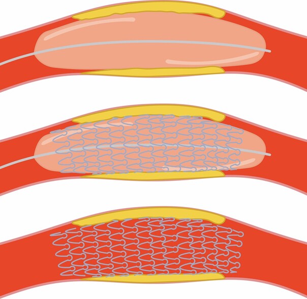 Illustration af tre kranspuls&aring;rer. Resterende beskrivelse findes i billedtekst.