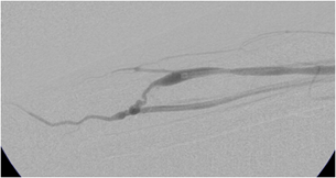 F&oslash;r indgrebet er blod&aring;ren utydelig.