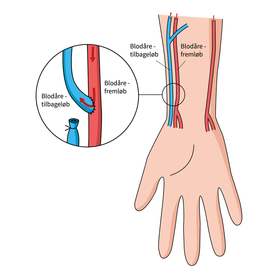 Illustration af AV-fistel i underarmen. En vene forbindes med en arterie, s&aring; blod fra arterien ledes ind i venen. Pile p&aring; illustrationen viser blodets retning gennem forbindelsen.

