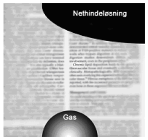 Illustration af dit synsfelt med nethindel&oslash;sning