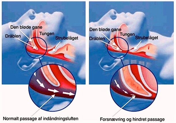 Til venstre er normal passage af indåndingsluften illustreret. Til højre er forsnævring og hindret passage af indåndingsluften illustreret.