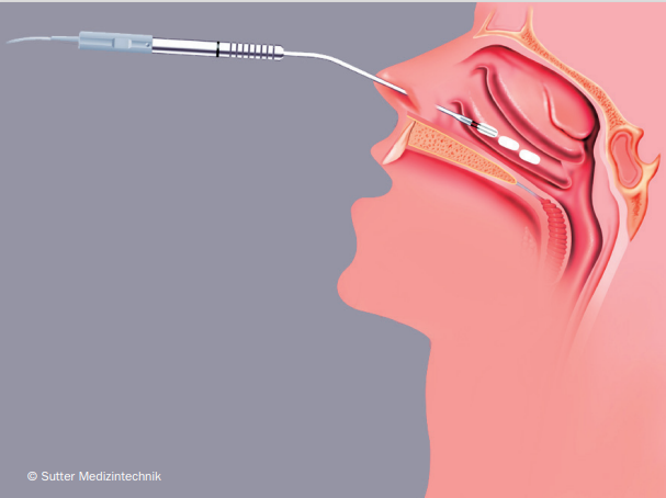 Et tyndt nålelignende instrument føres ind gennem næseboret, mens behandlingen udføres.
