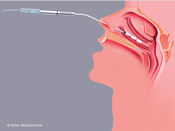 Et tyndt n&aring;lelignende instrument f&oslash;res ind gennem n&aelig;seboret, mens behandlingen udf&oslash;res.