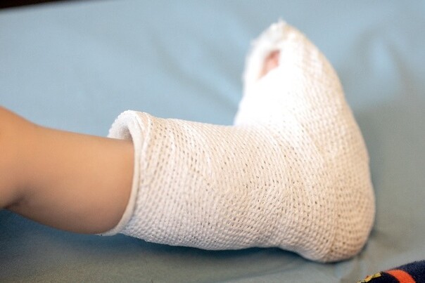 Gips p&aring; barnefod.