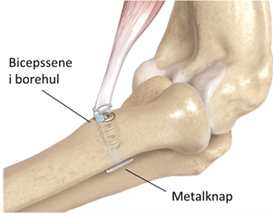 Billede af bicepssene der h&aelig;ftes i et borehul i spolebenet med tr&aring;d og metalknap.