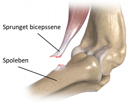 Et billede af albueleddet, hvor bicepssenen er sprunget ved spolebenet.