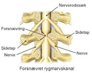 Snæver rygmarv.
