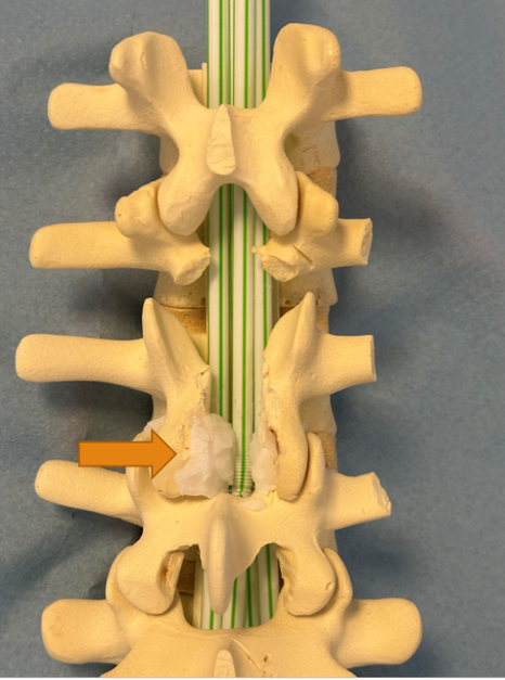 P&aring; billedet ses, hvordan rygmarvskanalen forsn&aelig;vres af fortykket v&aelig;v ved slidgigt. V&aelig;ves illustreres p&aring; billedet med gel&eacute;-lignende hvide klumper.