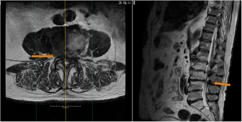 Billedet viser et udsnit af en MR-skanning, hvor man kan se en forsn&aelig;vring af en del af rygs&oslash;jlen som f&oslash;lge af slidgigt.