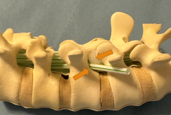 P&aring; billedet ses, hvordan spinalnerven er klemt, inden den forlader rygs&oslash;jlen. Dette skyldes v&aelig;v, der forst&oslash;rres ved slidgigt, hvilket er illustreret med noget gennemsigtigt gel&eacute; p&aring; billedet.