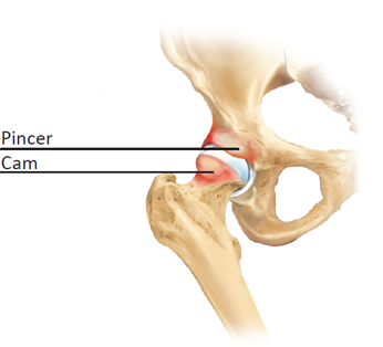 Hofte, hvor brusk er kommet i klemme i hoftesk&aring;len og ledl&aelig;ben.