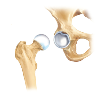 Hofte, hvor ledl&aelig;ben er beskadiget.