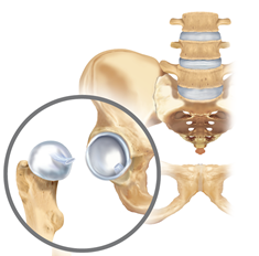 Hofte, hvor hoftesk&aring;l og l&aring;rbensknogle ikke er beskadiget.