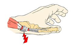 Forsn&aelig;vring omkring senerne ved tommelfingeren.