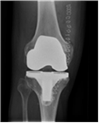 røntgenbillede af knæ med indsat helprotese