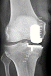 røntgenbillede af knæ med indsat delprotese