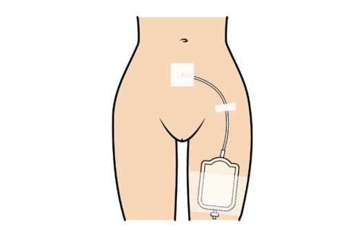 Kvindelig underkrop med topkateter og urinpose fikseret p&aring; ben.