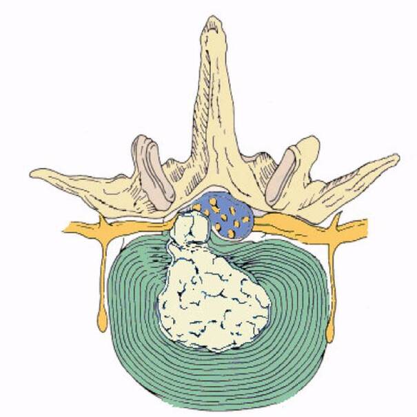 Ryghvirvel hvor kernen er presset ud til nerven