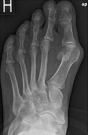 Røntgenbillede af fod med knyst og skæv storetå.