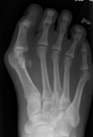 Røntgenbillede af fod med knyst og skæv storetå.