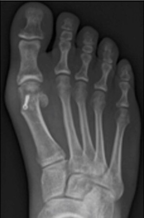 Røntgenbillede af fod, hvor knysten er savet af, og storetåen er rettet op.