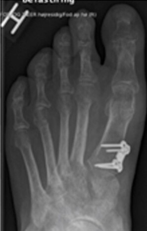 Røntgenbillede af fod, hvor knysten er savet af, og storetåen er rettet op.