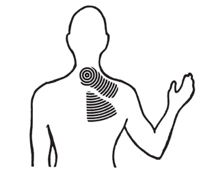 Markering af hvor irritation af nerverod i nakken opleves langs nakken eller ned af armen.