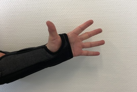 Foto af underarm og h&aring;nd med 5 spredte fingre, der str&aelig;kkes. Form&aring;let er at illustrere &oslash;velsen, der ogs&aring; er beskrevet med ord.