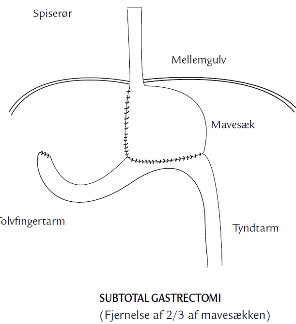 Operation For Svulst I Mavesækken