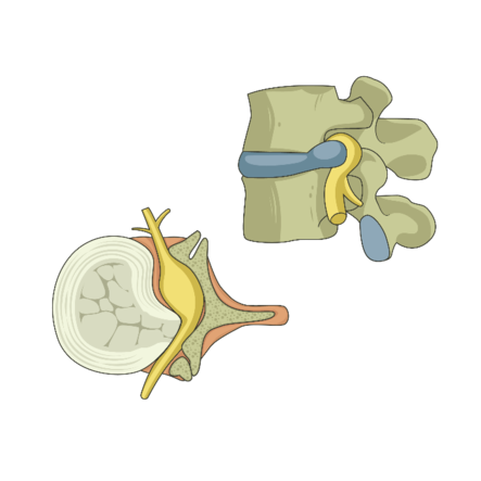 Hvirvler med diskusprolaps
