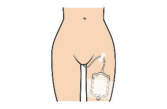 Kvindelig underkrop med kateter mellem urinr&oslash;r og kateterpose