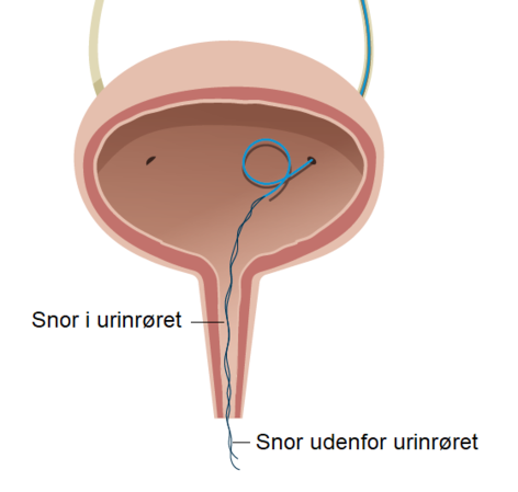 Snoren ses i blæren, urinrøret og udenfor urinrøret